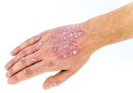 Does Ayurvedic Treatment Work for Psoriasis?