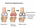 Total Knee Replacement Surgery in Dubai - Nanoori Spine & Joint Clinic