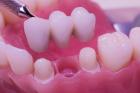 Dental Crown and Dental Bridge treatment in Dubai UAE
