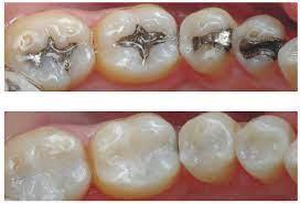 Teeth filling in Dubai AED 250  White color teeth filling cost in Dubai