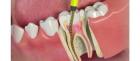 Root Canal Treatment in Dubai At AED 600