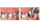 Teeth Extraction in Dubai AED 350