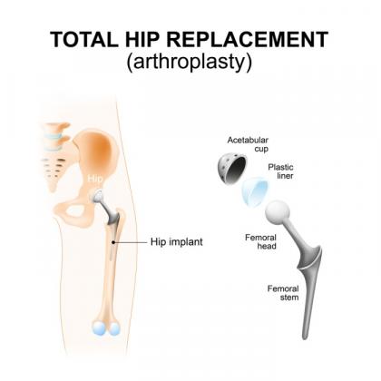 Hip Surgery in Dubai - Nanoori Orthopedic & Spine Centre