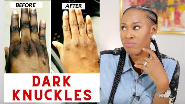 Dark Knuckle Whitening Serum In Anchorage City in Alaska Call +27710732372 Get Rid Of Vitiligo In Coleman Town in Texas, United States