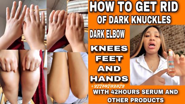 Skin Bleaching In Ketchikan City in Revillagigedo Island, Alaska Call ☏ +27710732372 Scars And Stretch Marks Removal Cream In Lockhart City in Texas